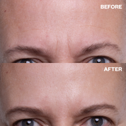 Forehead Wrinkle Patches